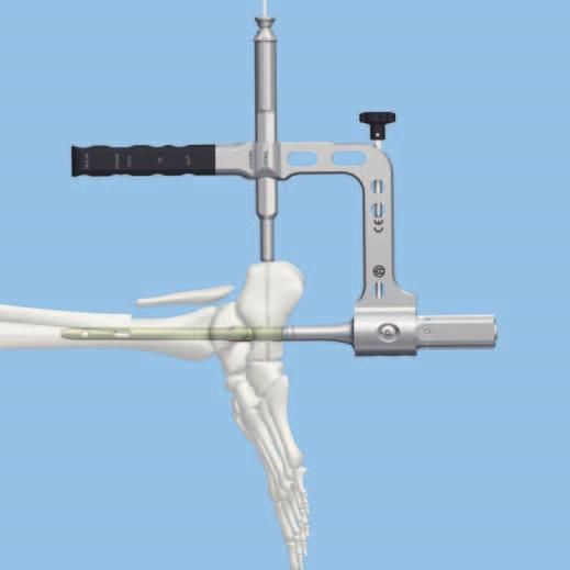 Standard Distal Locking Notes Distal locking first is recommended, to allow later compression across joints being fused. Standard distal locking consists of two 6.0 mm locking screws.
