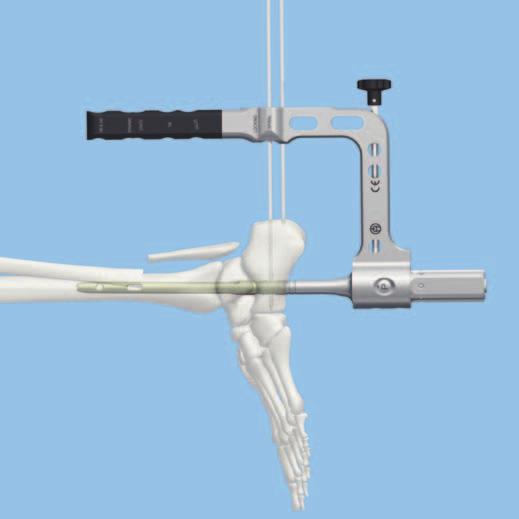 Standard Distal Locking 2 Maintain aiming arm in position Instrument 03.010.115 Guide Wire 3.2 mm, length 290 mm Insert a second 290 mm guide wire under power through the hole in the aiming arm.