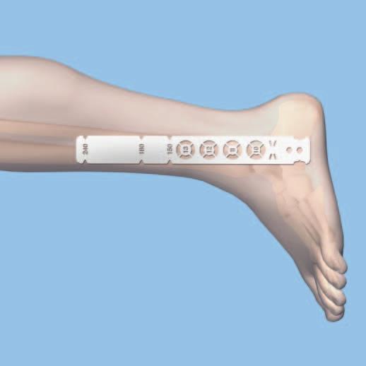 3 Determine nail length and diameter Instrument 03.008.001 Radiographic Ruler Measure length Position the C-arm for a lateral view of the distal tibia and subtalar joint.