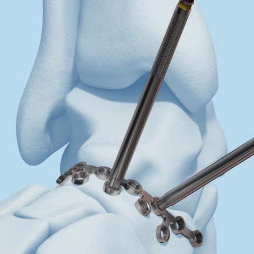 It may be necessary to open the talonavicular joint capsule to allow visualization of the joint.