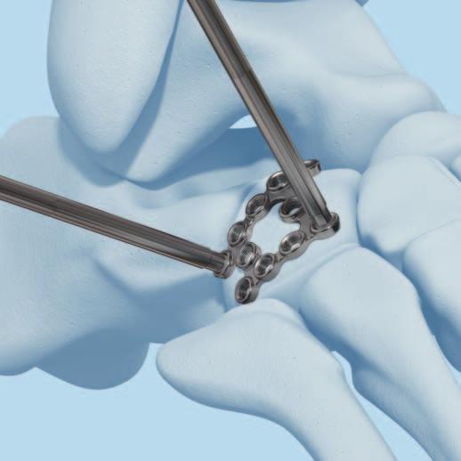 One of the main objectives of cuboid fracture management is restoration of the lateral column length and articular surface. 2 Contour the Plate Instrument 329.922 Bending Pin for 2.4/ 2.