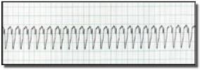 (a) (b) (c) Figure 2: Heart Rhythms: (a) Sinus Rhythm, (b) Ventricular Tachycardia Rhythm, (c) Ventricular Fibrillation Rhythm Figure 2(a) shows the normal heart rhythm called sinus rhythm, Figure