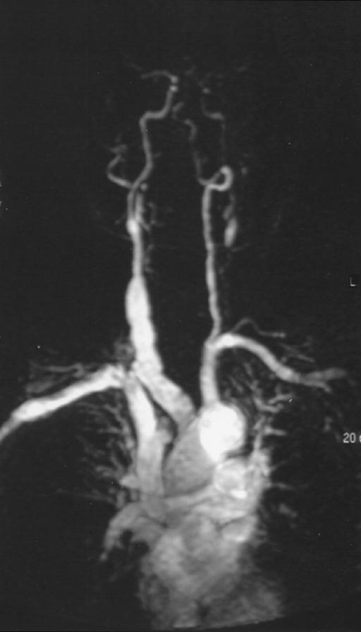 D, High-resolution contrast-enhanced MR angiography carotid images (TR/TE, 4.0/1.