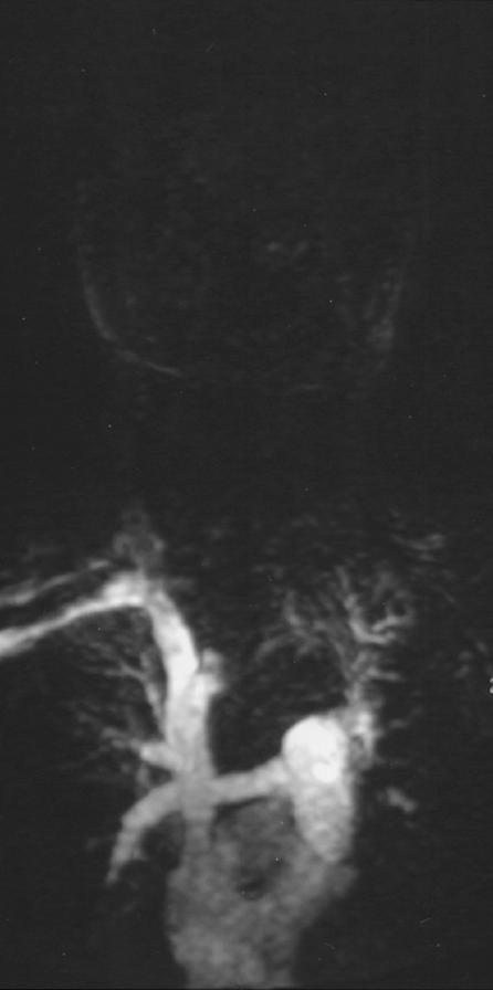 Each maximum-intensity-projection image is reconstructed with 24 slices of source images. Fig. 4. 35-year-old man with intralobar sequestration.