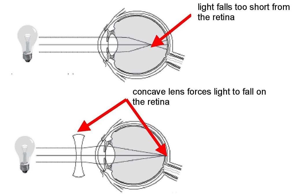 using a convex lens of appropriate power. This is illustrated in below figure. Eyeglasses with converging lenses provide the additional focusing power required for forming the image on the retina.