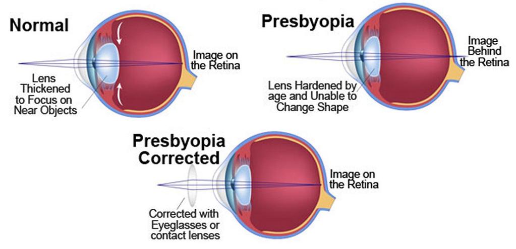 PRESBYOPIA Presbyopia occurs at the age of 40 years and its main symptom is reduced near vision.