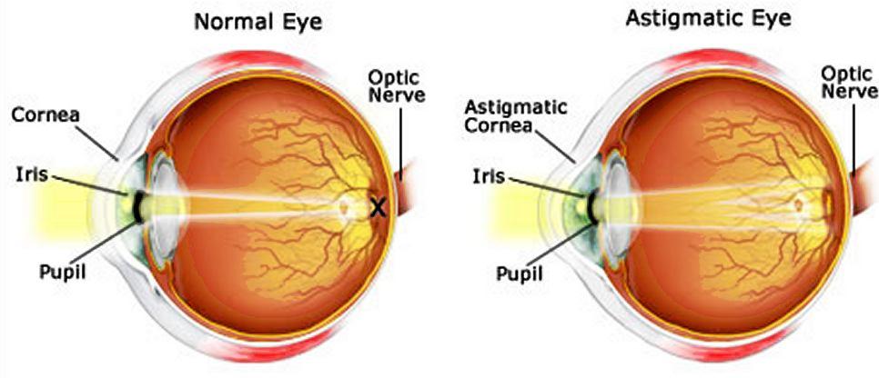 In astigmatism, images focus in front of and beyond the retina, causing both close and distant objects to appear blurry (see below figure). INTEXT QUESTIONS PAGE No. 190 1.