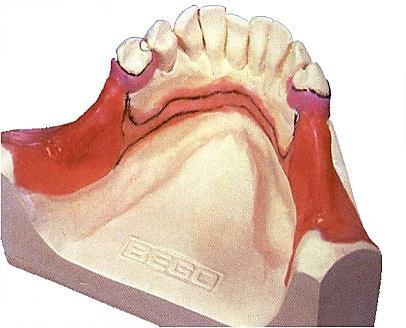 In edentulous area of upper jaw the thickness of wax is 0,5 0,8 mm (Fig. 1.1).