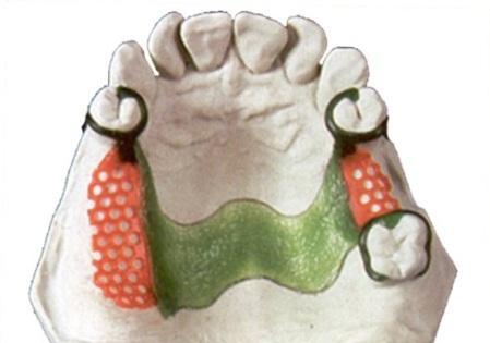 Constructing the wax pattern of cast partial denture.