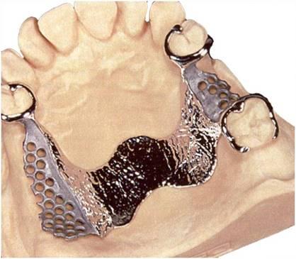 . Рис. 11. Metal base of upper jaw (1) and lower jaws dentures. (2) (Markskors R.