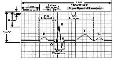 Figure (2) Normal ECG in personal computer (PC) by using different types of sensors/ electrodes and leads and appropriate conditioning units like amplification and filtering.
