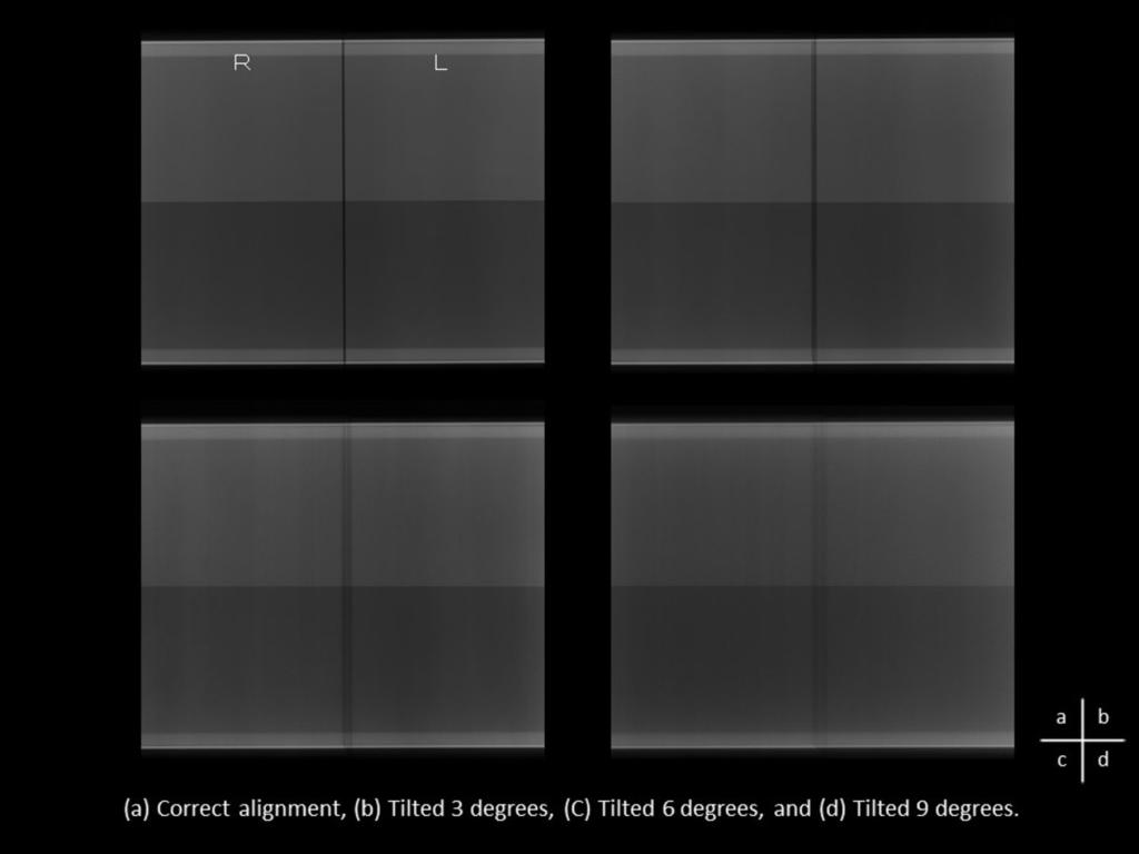 CNR in correct alignment was the same as the exposure with Grid. (Fig.