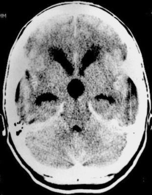 CLEAR-IVH Trial 52 bệnh nhân xuất huyết trong não thất (IVH) Nghiên cứu mở, bơm rt-pa vào trong não thất Tác dụng không mong muốn Xuất huyết triệu chứng 4% Viêm não thất nhiễm trùng (Bacterial