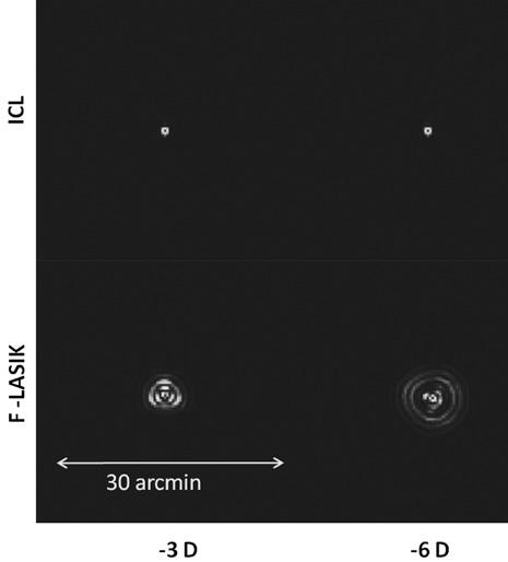 Implantable collamer lens and femtosecond laser for myopia: comparison using an adaptive optics visual simulator Figure 3.