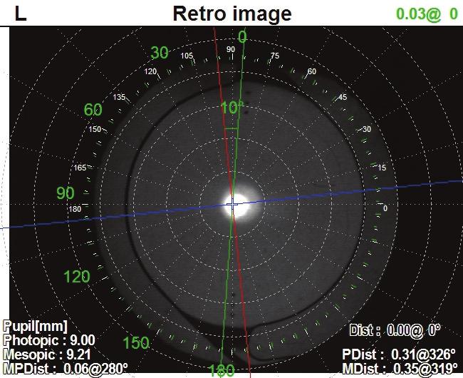 Pursuit of Perfection How the OPD-Scan III assists me in providing nearly perfect refractive cataract surgery results. Refractive cataract surgery is a growing field.