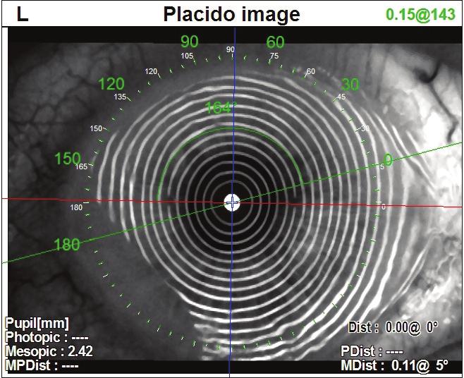 An estimated one quarter of all patients over the age of 40 manifest significant astigmatism, 1,2 while nearly 20% of cataract patients have more than 1.5 diopters of preoperative corneal astigmatism.