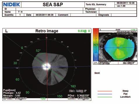 The photopic eye image complete with axial topographic overlay verifies the steep axis. Figure 4. Toric Summary-Orientation of an Alcon AcrySof toric IOL in relation to steep meridian.