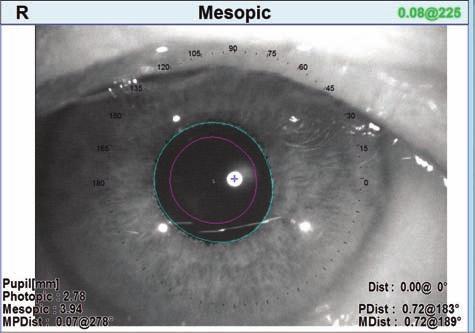 We mark the patient while he's in a seated position to rule out cyclotorsion and let those marks guide us during surgery. For example, the OPD-Scan III lets me mark a blood vessel on the sclera.