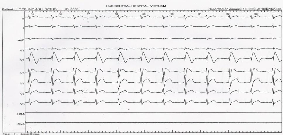 Hình 2b: Điện tim chuyển
