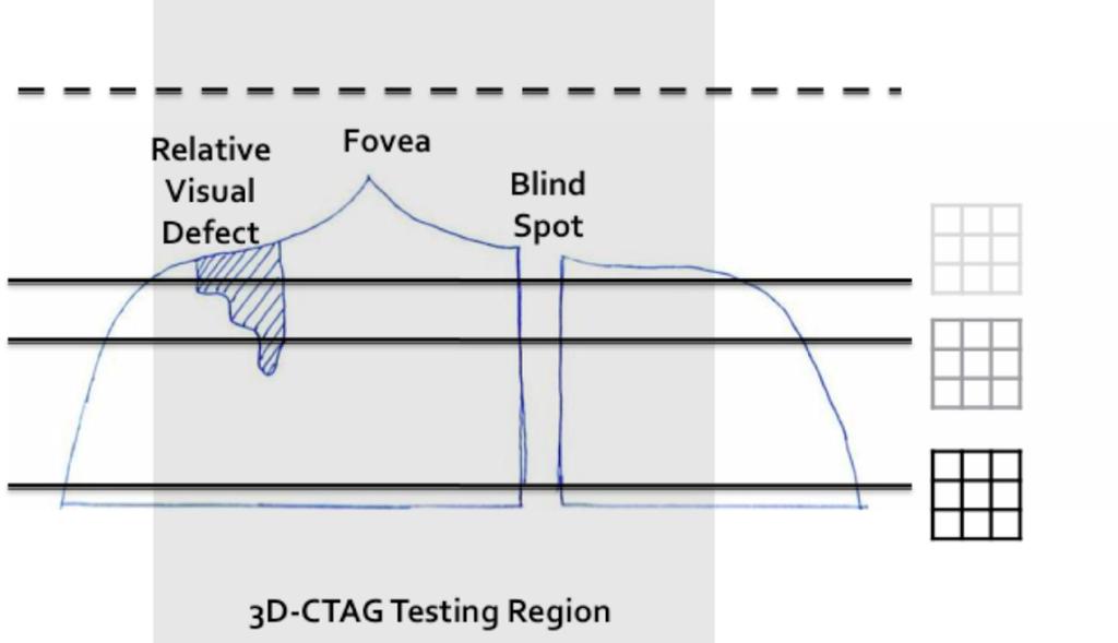Relative Visual Defect Fovea Blind Spot Amsler Grids at different contrast levels I 1 I 3D -CTAG Testing Region Figure 4. Depiction of hill-of-vision in a vertical cut.