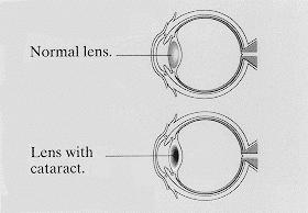 The EYE: The Lens Hyper-mature cataract 27 The EYE: The Lens Refraction Light changes direction when it passes from