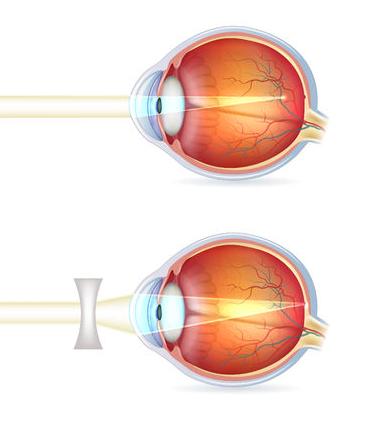 For eyes with refractive error, the lens will focus light before or after the retina.