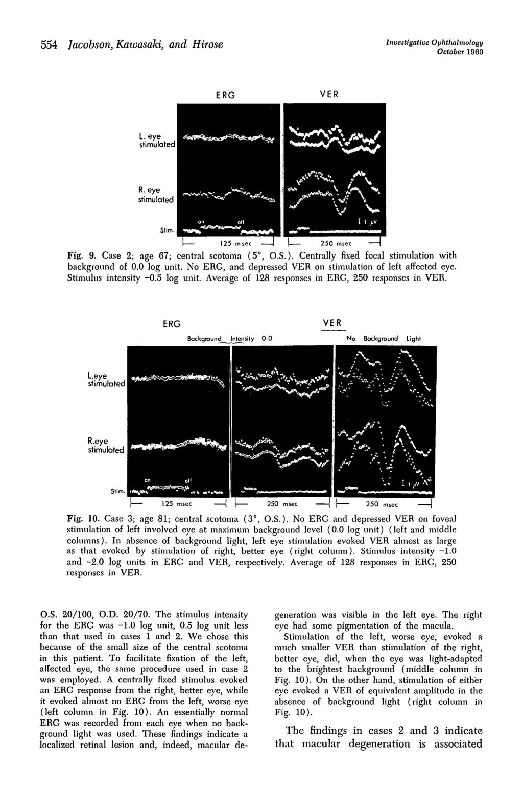 554 Jacobson, Kawasaki, and Hirose Investigative Ophthalmology October 1969 ERG VER L. eye stimulated R.eye stimulated Stim. I Fig. 9. Case 2; age 67; central scotoma (5, O.S.).