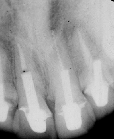 DENSITY: Radiographic density represents the degree of darkness of an image. White areas (e.g., metallic restorations) have no density and black areas (e.g., air spaces) have maximum density.