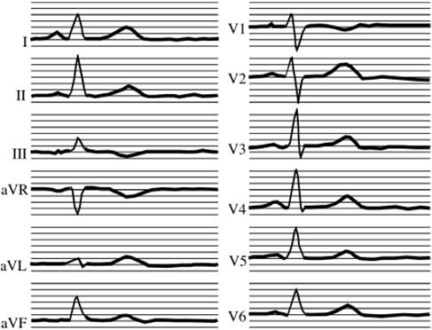 Detection and analysis of ECG/EKG Andreas Neubauer I Slide 17 I 18.11.