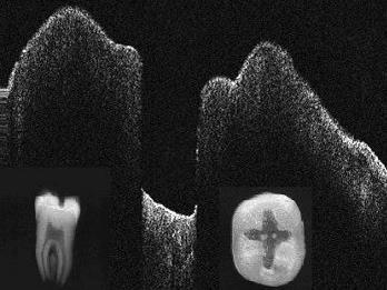 Examples : Medical Imaging (III) OCT in Dentistry