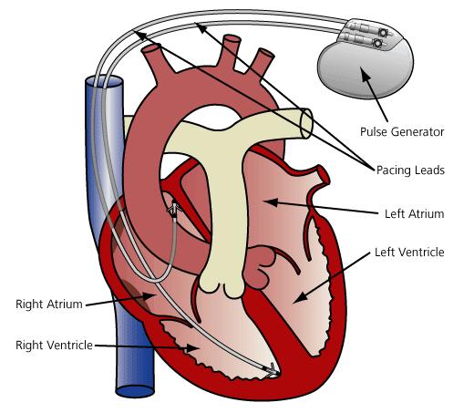 1. Introduction 1.1. Background With the development of healthcare technology, more and more advanced medical implant devices (such as pacemakers) are required.