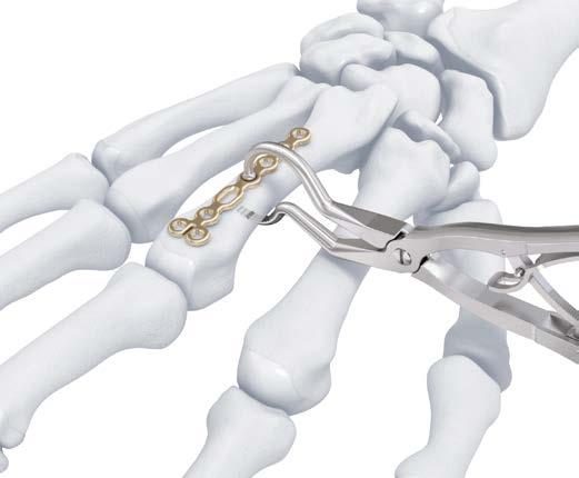 FEATURED INSTRUMENTS Reduction Forceps for Cortex Screws (03.130.