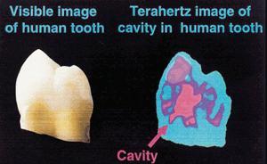 What Terahertz cannot do: Terahertz Bubbles Medical imaging Sub-millimeter penetration depth in tissue and teeth Published