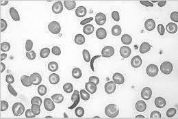 Fig. 1 RGB image of Blood Smear 2. Preprocessing: In order to process the image in an efficient manner the test image Fig. is converted from RGB to Gray scale.