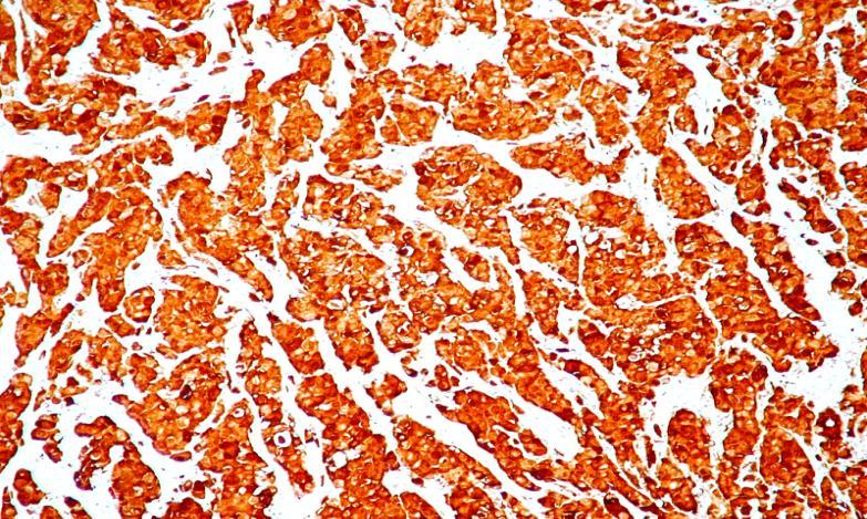 tumorile cu celulele epiteloide având o specificitate similară cu cea a HMB-45 dar o sensibilitate uneori mai mare fiind utilizat în asociere cu