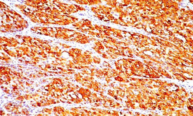 pozitivă în unele melanoame negative la aceşti markeri. Microfoto nr.69 Col. IHC 20x (DAB) M.M. nodular acromic S100 intens pozitiv în toate celulele tumorale Microfoto nr.