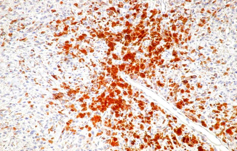 x (AEC) M.M. nodular, Clark V VEGF+ în celulele tumorale dispuse perivascular 9.1.