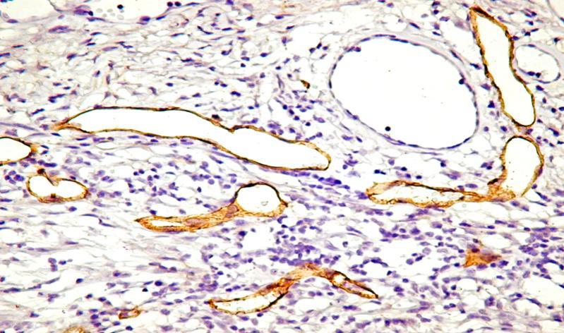 Peritumoral, vasele limfatice evidenţiate prin pozitivare la D2-40 (colorare brună a endoteliului) au prezentat perete
