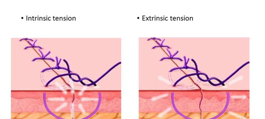 Intrinsic tension is the tension with the suture loop. This is due to putting too much tension on the tissue with your suture.