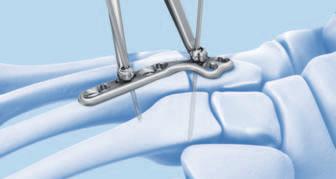 Revision plates Revision plates are offered with 0 dorsiflexion and an extra variable angle locking hole to secure a bone block Left and right plates Proximal and distal reamers Used