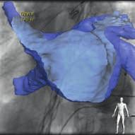 CTO Navigator provides an overlay of a 2D exposure run over the previous acquired segmented cardiac CT data.