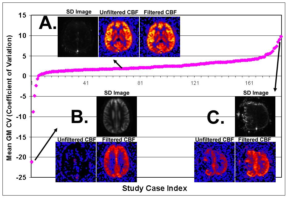 Figure 6. Mean coefficient of variation (CV) values were calculated for gray matter voxels for each perfusion case.