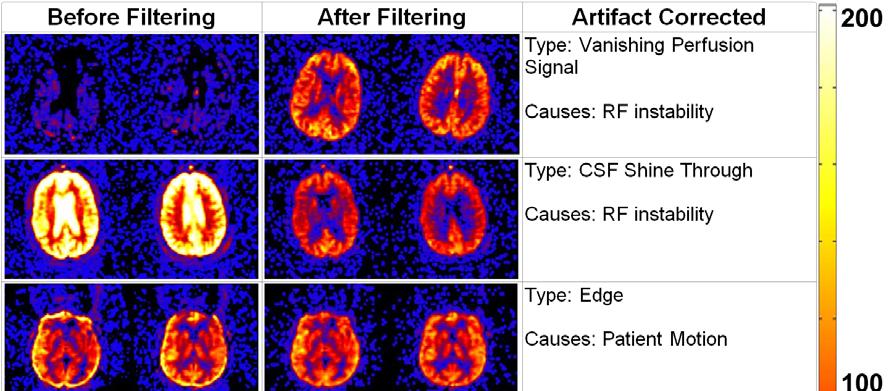 Figure 7. Examples of clinical CBF maps before and after ASL filtering for both unstable and stable cases.