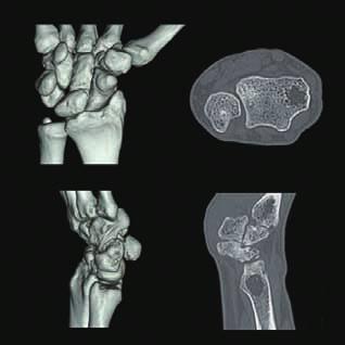 Bone cyst reconstructed