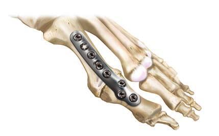 5º valgus TMT Fusion Plates Proximal screw cluster and low-plate profile provide stable fusion fixation 1.