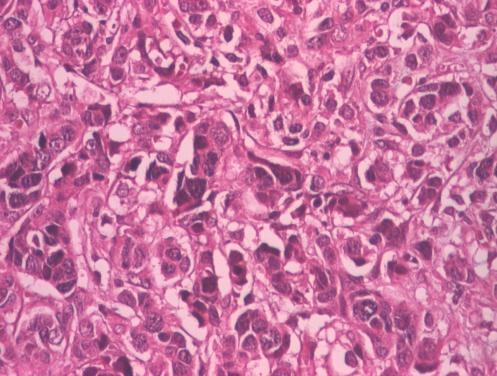 Carcinoamele mamare ductal invazive G3 au prezentat în cea mai mare parte nuclei cu variaţie marcată de mărime şi formă, încadrate ca nuclei de grad 3 (Fig nr. 15)