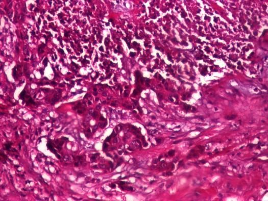 41% din carcinoamele mamare ductal invazive au prezentat necroză, întâlnită în special în cazurile cu pattern de creştere solid, cu celule maligne dispuse sub formă de plaje largi.