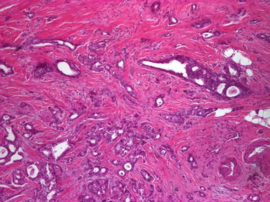 În cazuistica studiată am urmărit asocierea carcinomului mamar cu leziunile proliferative intraductale, de tipul hiperplaziilor epiteliale tipice sau atipice şi al carcinoamelor in