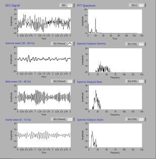 10 from the component signals of the brainwave the alpha wave is most predominant with 10 mv amplitude corresponding to 50% intensity. The beta and gamma waveforms have amplitude of 4-4.4 mv.