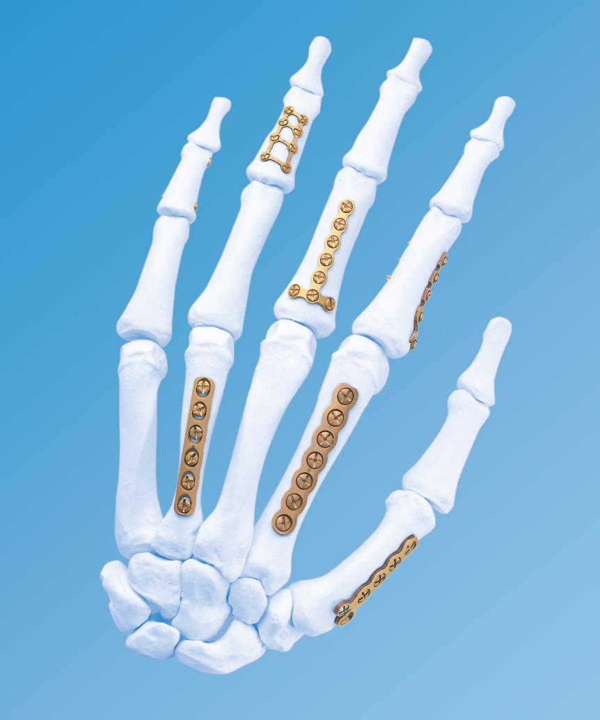 Titanium Modular Hand System. For fractures, replantations and reconstruction of the hand.